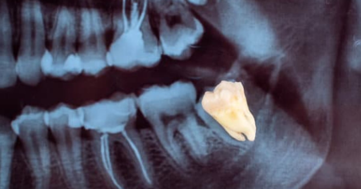 Resubmission for Wisdom Tooth Extraction