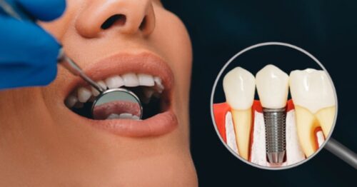 Dental Implants Successfully Billed To Medical Insurance