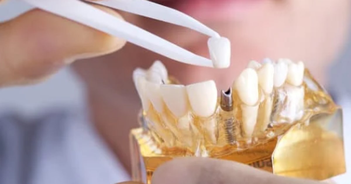 Simplifying Dental Caries Implant Medical Billing