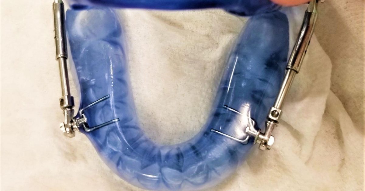 OSA Patient Treated With Custom Oral Device
