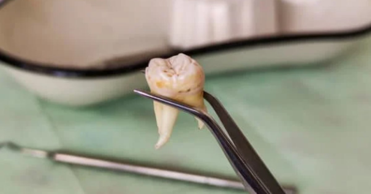 Orthopedic Surgery Preparation Tooth Extraction Successfully Billed to Medical Insurance